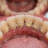 Pourquoi la plaque dentaire s&rsquo;accumule derrière les dents du bas ?