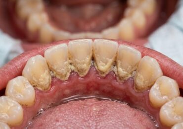 Pourquoi la plaque dentaire s&rsquo;accumule derrière les dents du bas ?